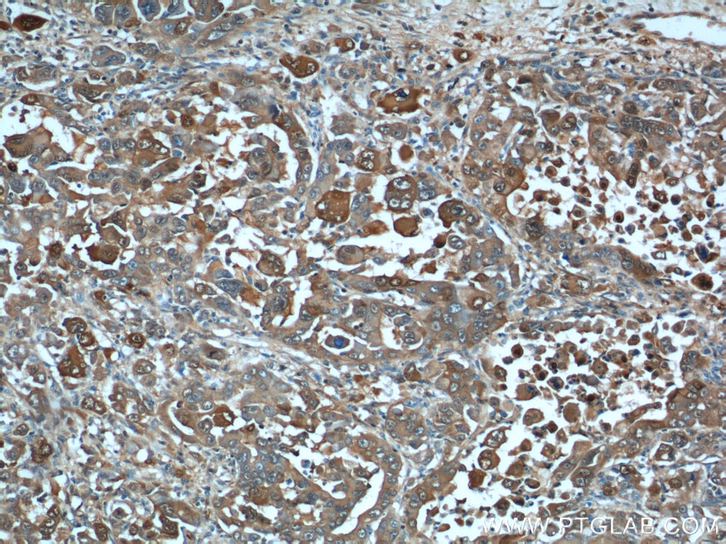 IHC staining of human liver cancer using 10245-1-AP