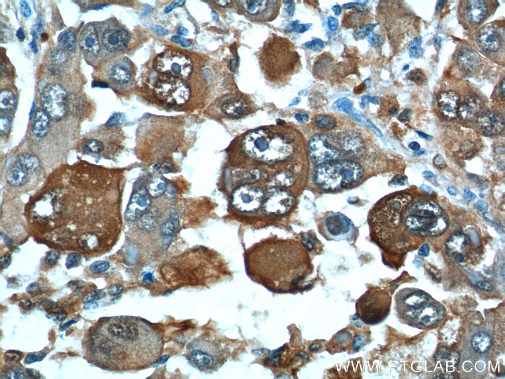 Immunohistochemistry (IHC) staining of human liver cancer tissue using S100A6 Polyclonal antibody (10245-1-AP)