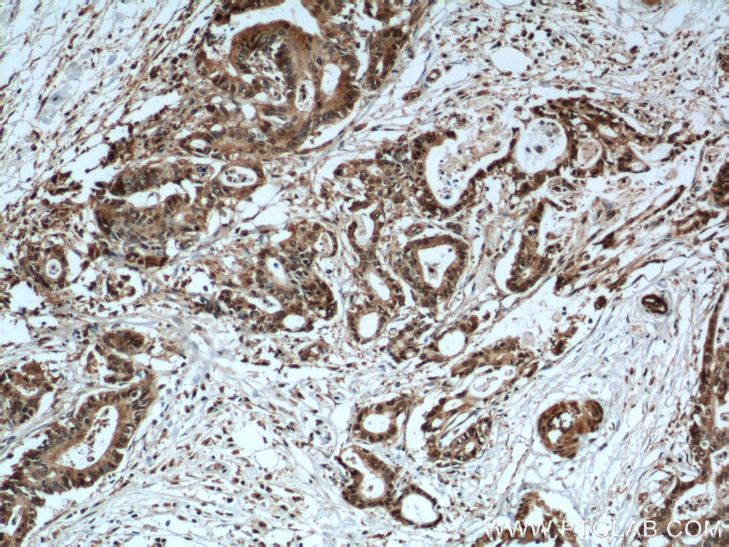 Immunohistochemistry (IHC) staining of human pancreas cancer tissue using S100A6 Polyclonal antibody (10245-1-AP)
