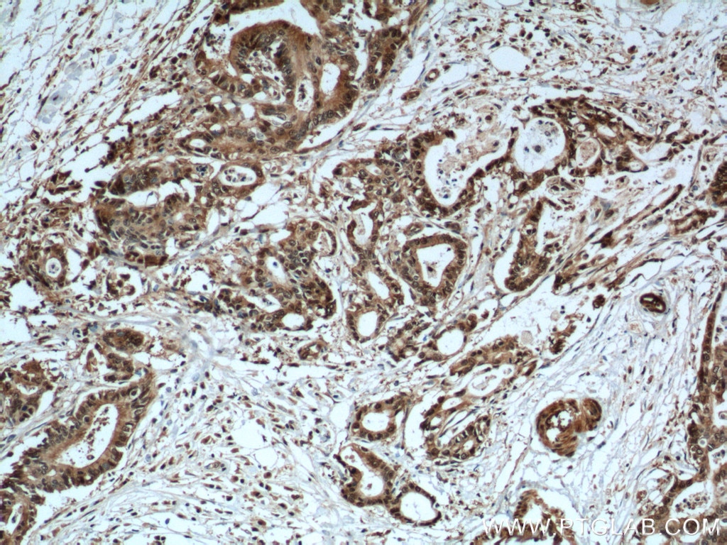 IHC staining of human pancreas cancer using 10245-1-AP