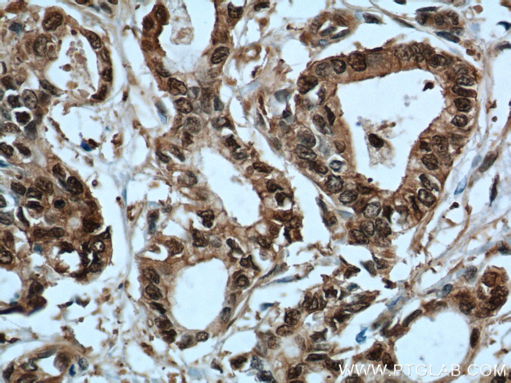 Immunohistochemistry (IHC) staining of human pancreas cancer tissue using S100A6 Polyclonal antibody (10245-1-AP)