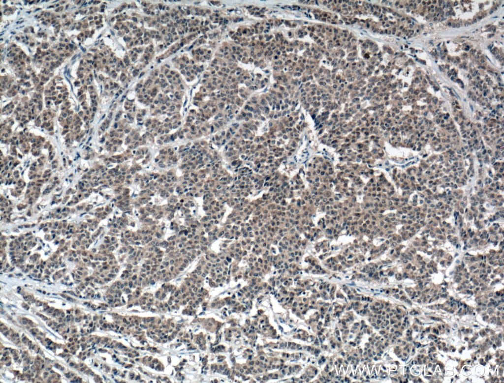 Immunohistochemistry (IHC) staining of human colon cancer tissue using S100A6 Monoclonal antibody (66098-1-Ig)