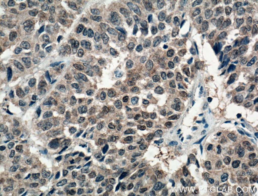Immunohistochemistry (IHC) staining of human colon cancer tissue using S100A6 Monoclonal antibody (66098-1-Ig)