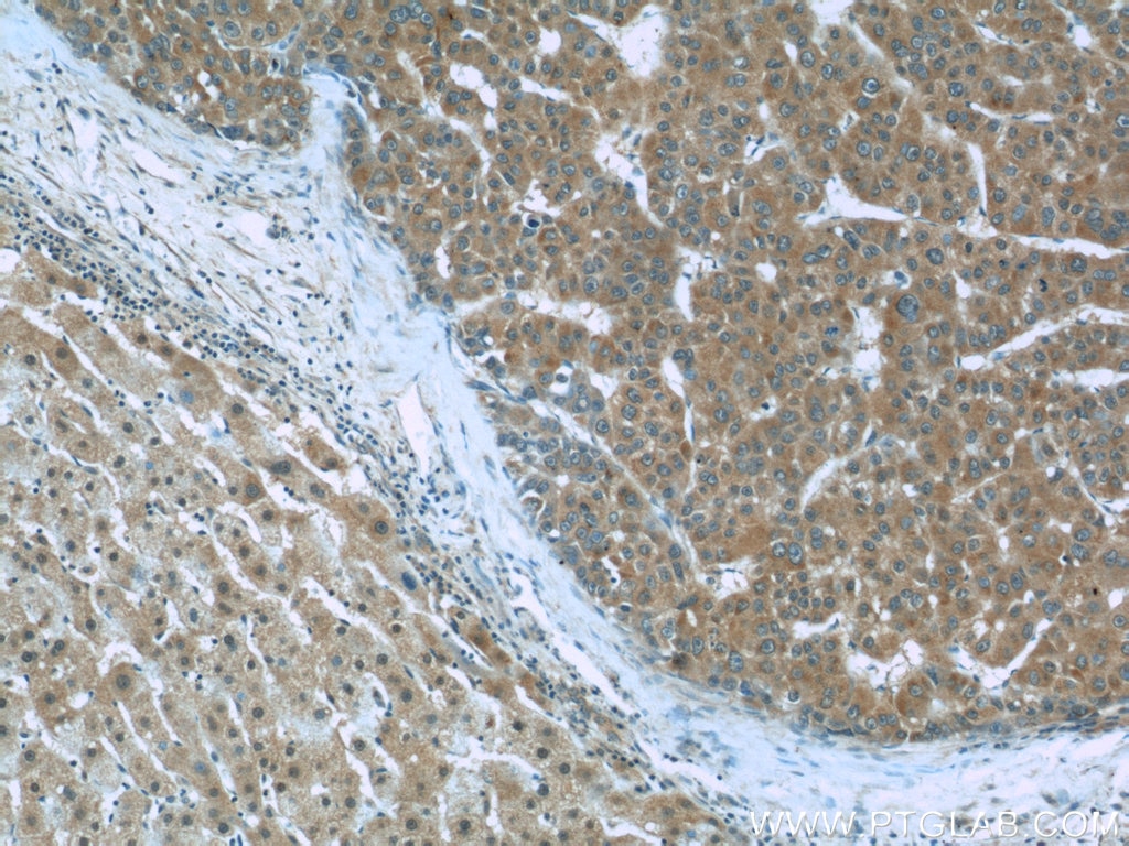 Immunohistochemistry (IHC) staining of human liver cancer tissue using S100A6 Monoclonal antibody (66098-1-Ig)