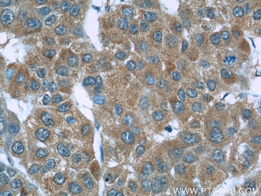 Immunohistochemistry (IHC) staining of human liver cancer tissue using S100A6 Monoclonal antibody (66098-1-Ig)