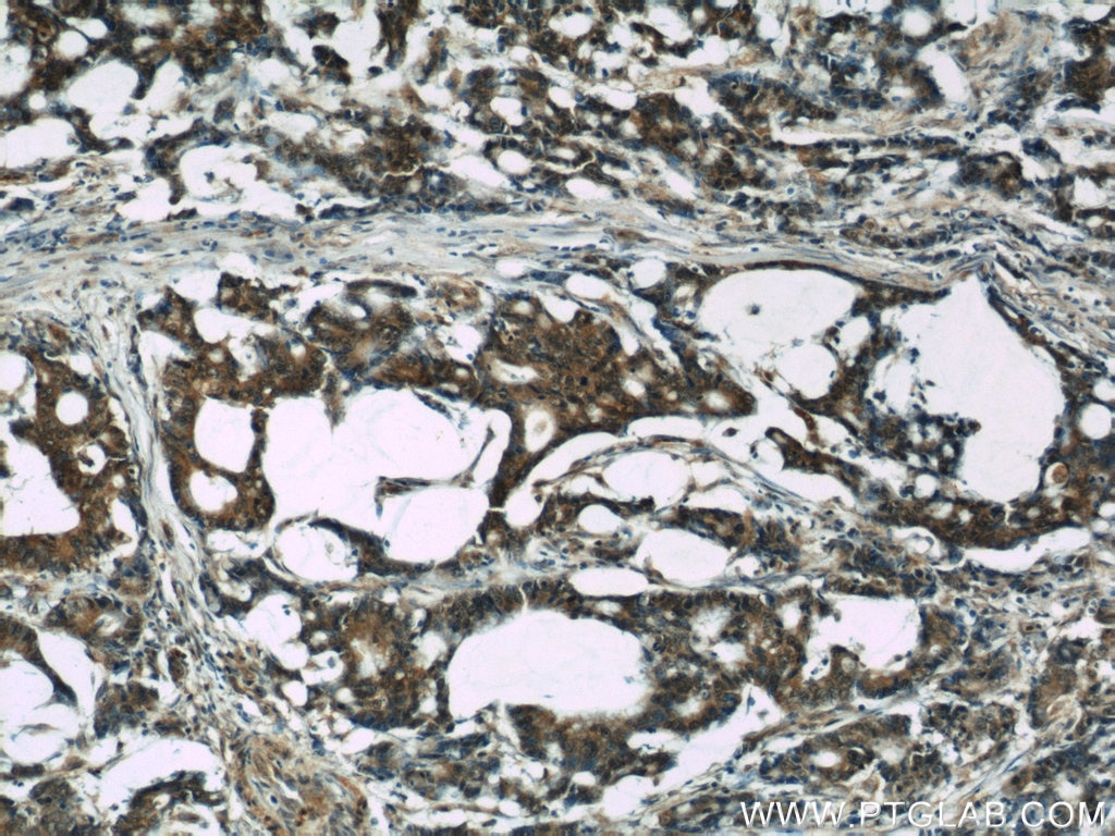 Immunohistochemistry (IHC) staining of human colon cancer tissue using S100A6 Monoclonal antibody (66098-1-Ig)