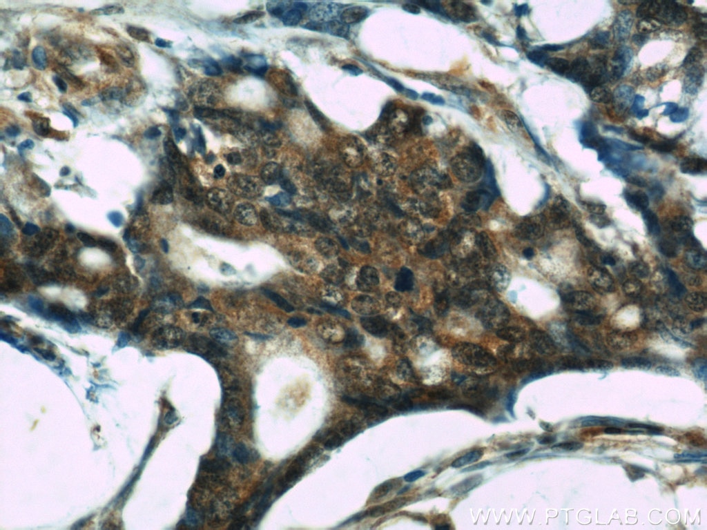 IHC staining of human colon cancer using 66098-1-Ig