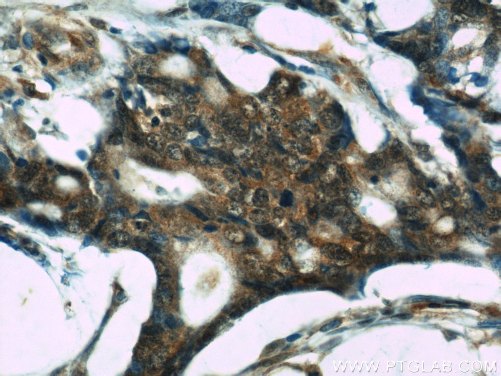 Immunohistochemistry (IHC) staining of human colon cancer tissue using S100A6 Monoclonal antibody (66098-1-Ig)