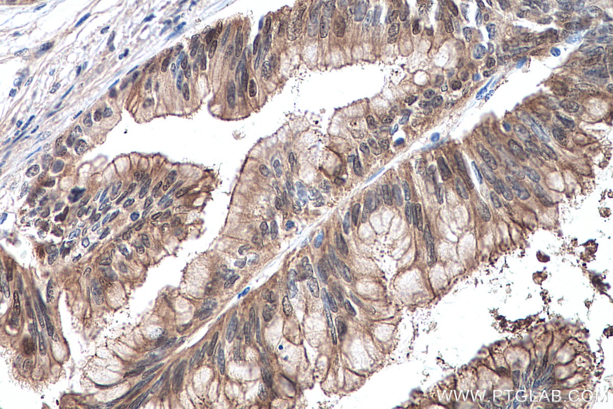 Immunohistochemistry (IHC) staining of human pancreas cancer tissue using S100A6 Monoclonal antibody (66098-1-Ig)