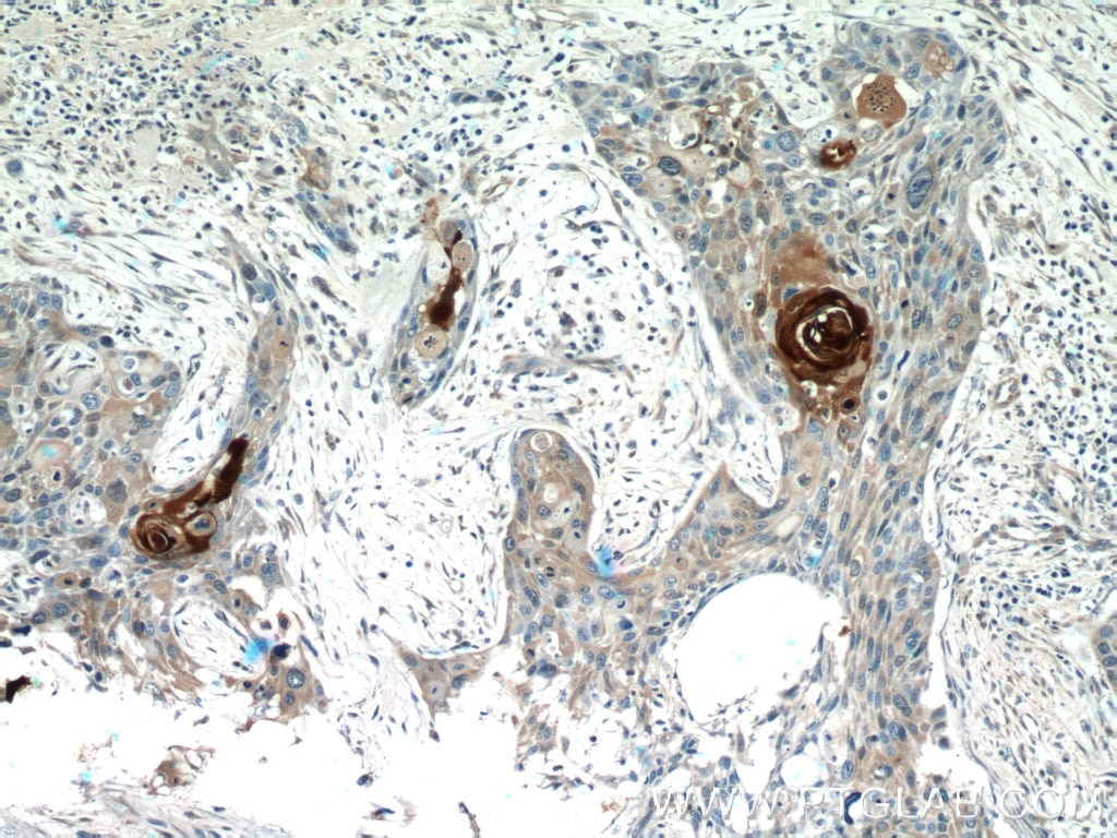 Immunohistochemistry (IHC) staining of human oesophagus cancer tissue using S100A7/Psoriasin Polyclonal antibody (13061-1-AP)