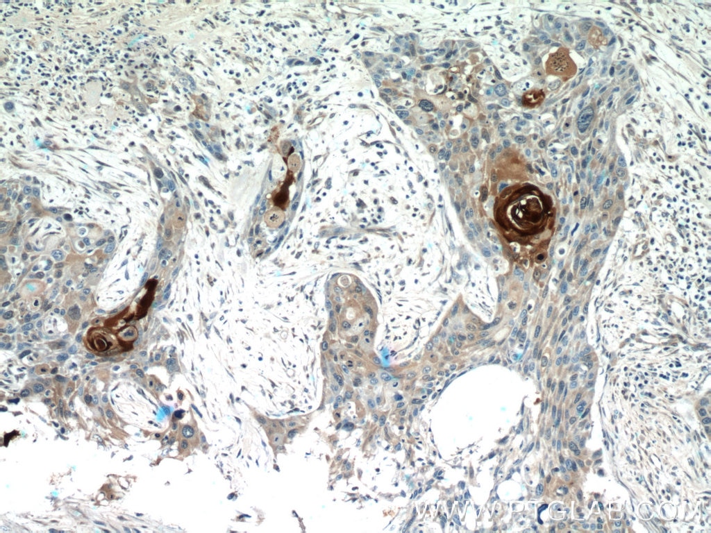 IHC staining of human oesophagus cancer using 13061-1-AP