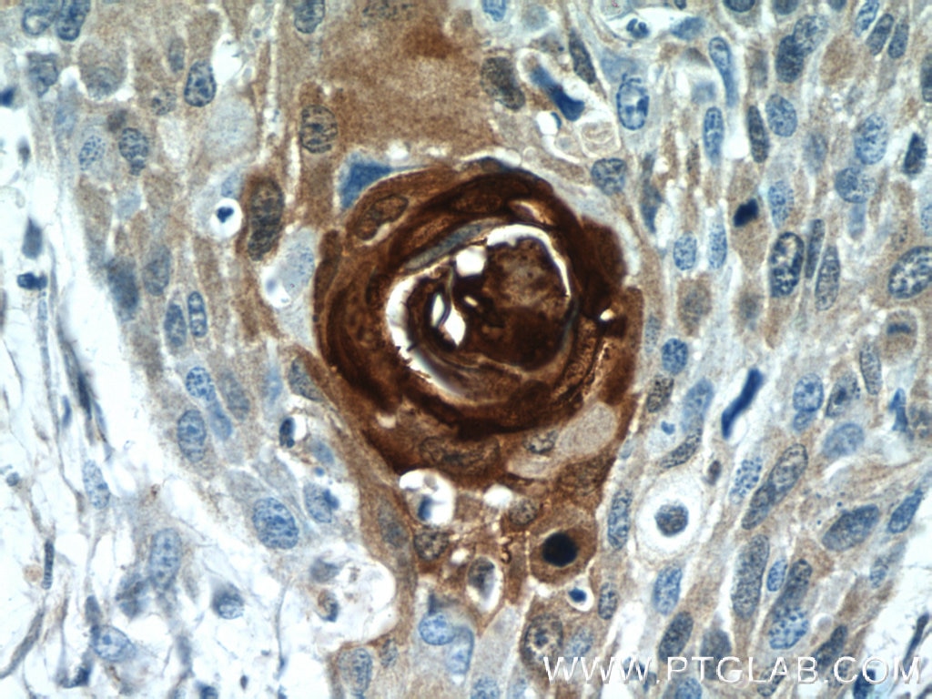 Immunohistochemistry (IHC) staining of human oesophagus cancer tissue using S100A7/Psoriasin Polyclonal antibody (13061-1-AP)