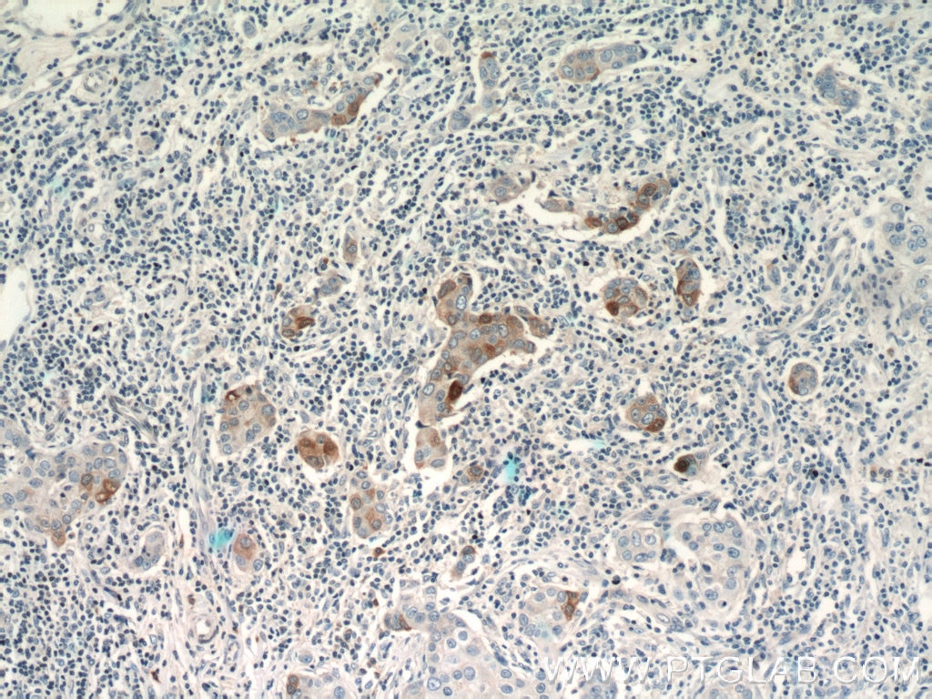 Immunohistochemistry (IHC) staining of human breast cancer tissue using S100A7/Psoriasin Polyclonal antibody (13061-1-AP)