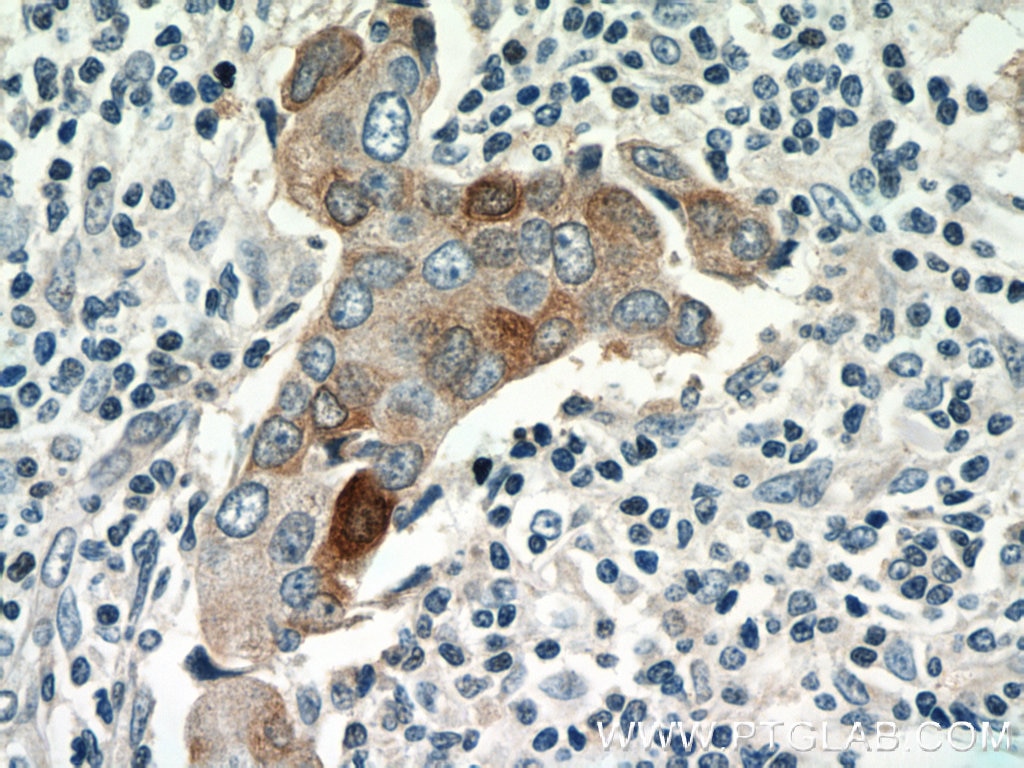 Immunohistochemistry (IHC) staining of human breast cancer tissue using S100A7/Psoriasin Polyclonal antibody (13061-1-AP)