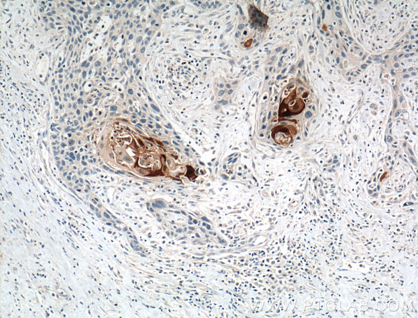 Immunohistochemistry (IHC) staining of human oesophagus cancer tissue using S100A7/Psoriasin Polyclonal antibody (26656-1-AP)