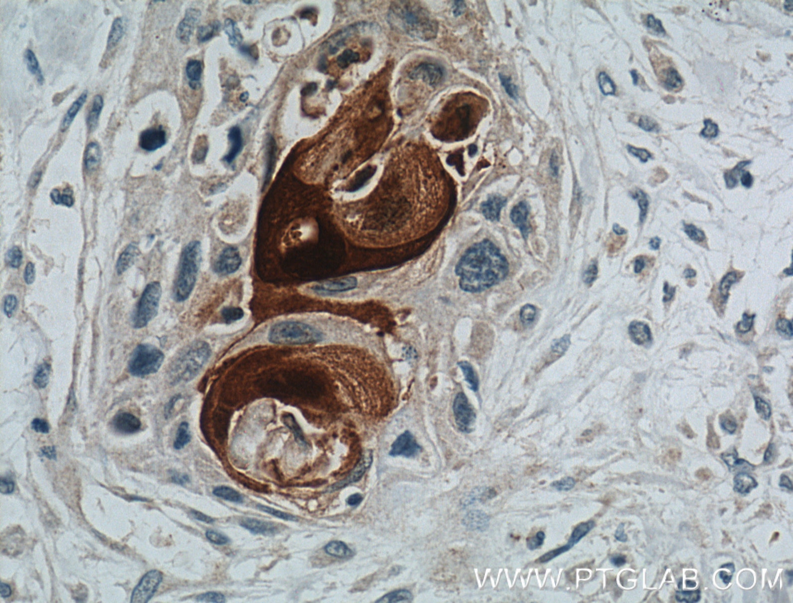 Immunohistochemistry (IHC) staining of human oesophagus cancer tissue using S100A7/Psoriasin Polyclonal antibody (26656-1-AP)