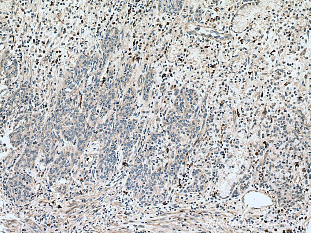 IHC staining of human stomach cancer using 15792-1-AP