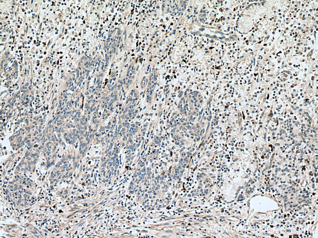 Immunohistochemistry (IHC) staining of human stomach cancer tissue using S100A8 Polyclonal antibody (15792-1-AP)