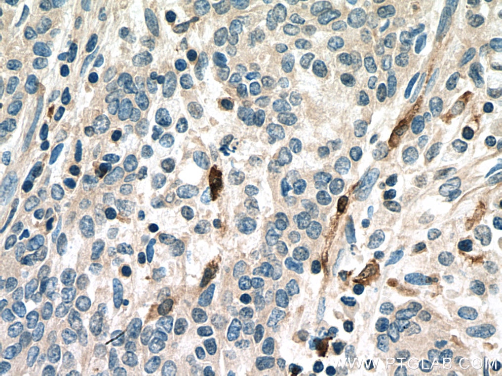 IHC staining of human stomach cancer using 15792-1-AP