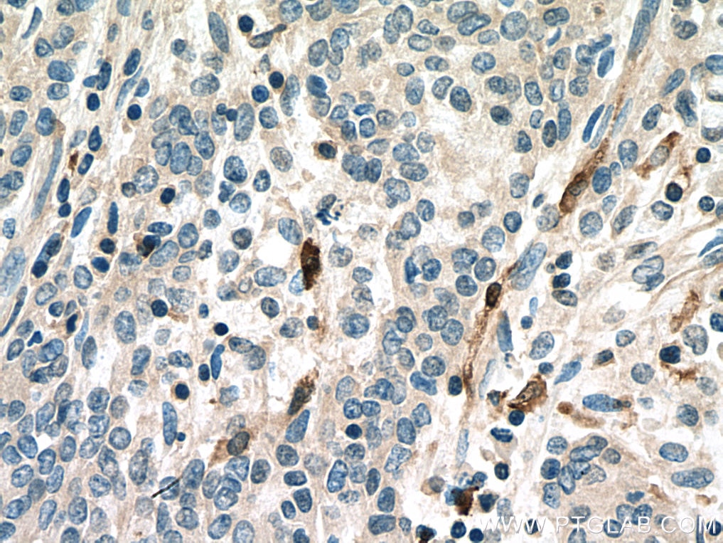 Immunohistochemistry (IHC) staining of human stomach cancer tissue using S100A8 Polyclonal antibody (15792-1-AP)