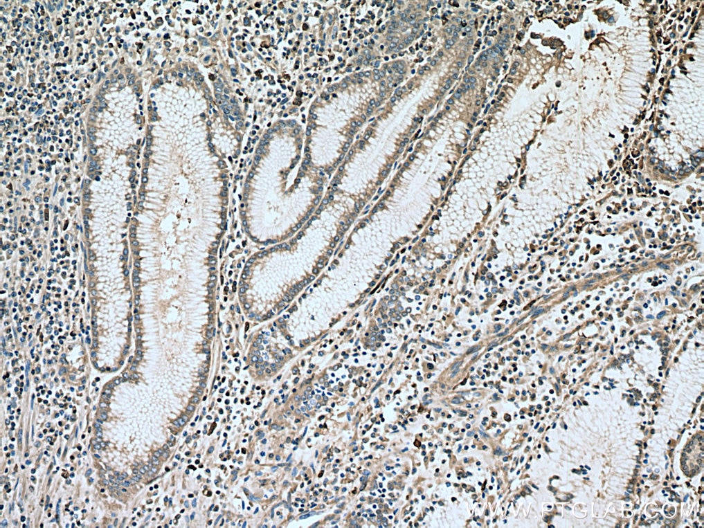 Immunohistochemistry (IHC) staining of human stomach cancer tissue using S100A8 Polyclonal antibody (15792-1-AP)