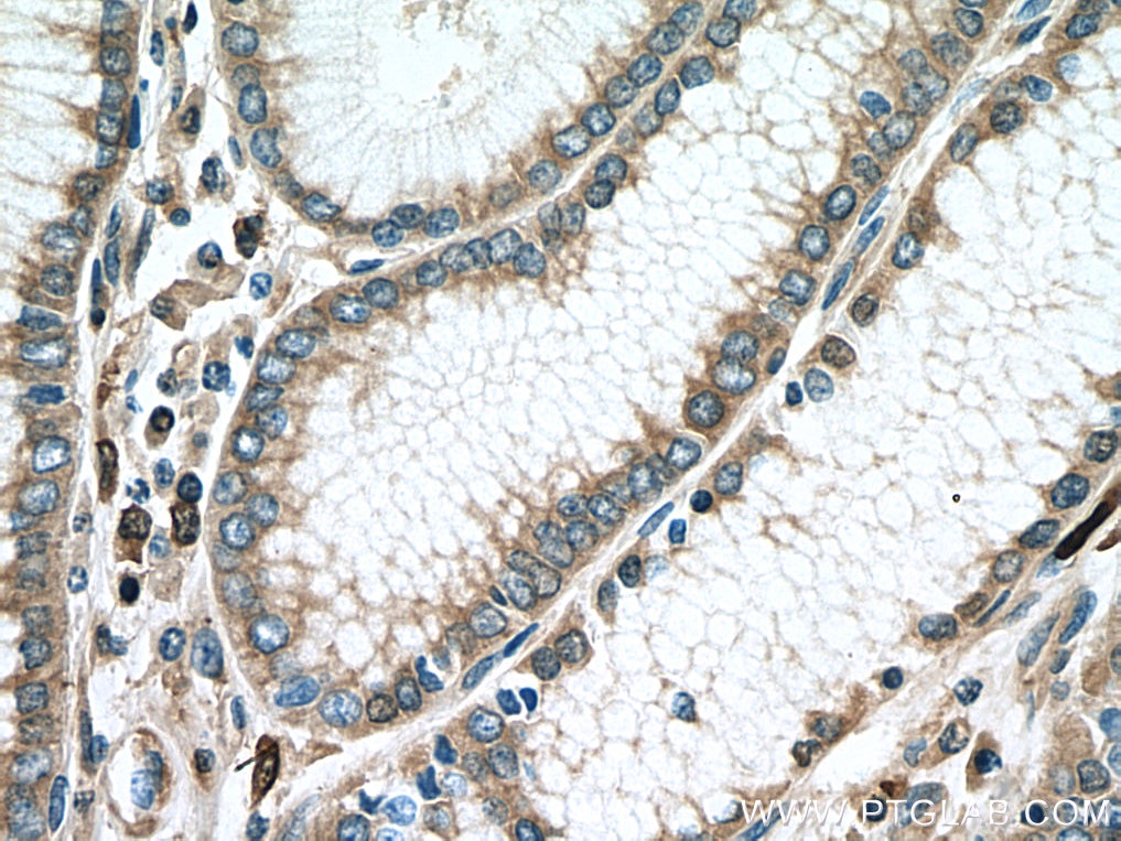 Immunohistochemistry (IHC) staining of human stomach cancer tissue using S100A8 Polyclonal antibody (15792-1-AP)
