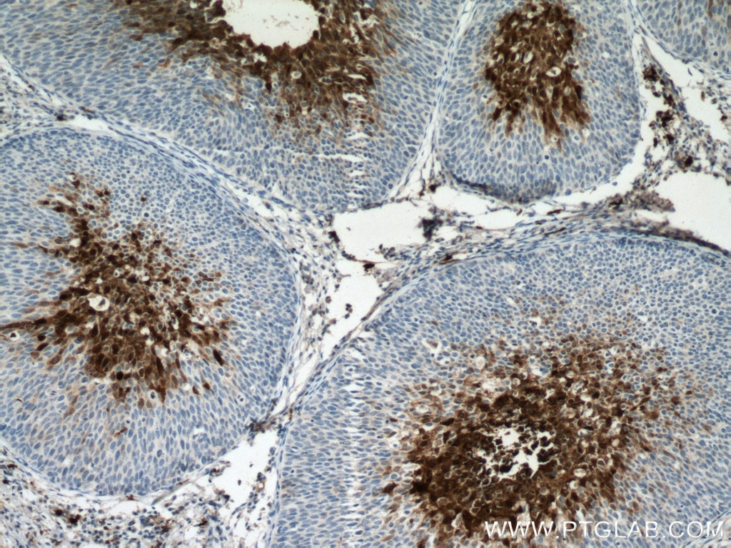 Immunohistochemistry (IHC) staining of human cervical cancer tissue using S100A8 Monoclonal antibody (66853-1-Ig)