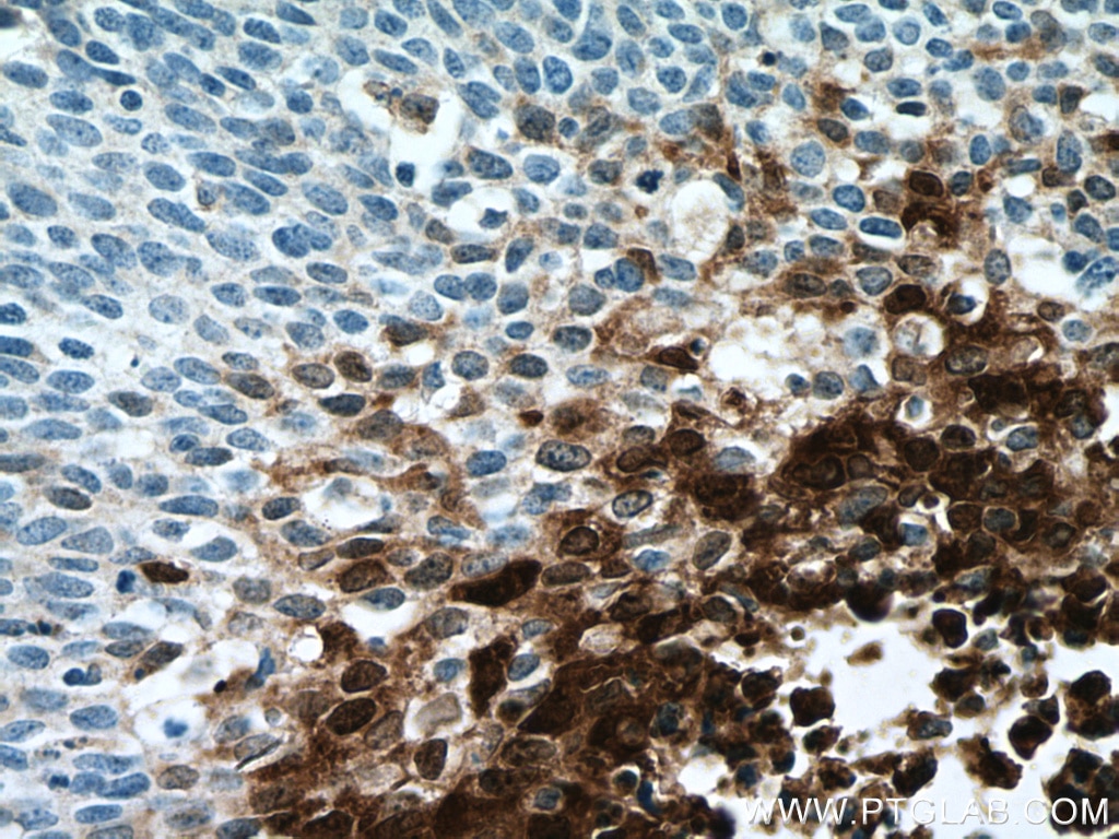 Immunohistochemistry (IHC) staining of human cervical cancer tissue using S100A8 Monoclonal antibody (66853-1-Ig)