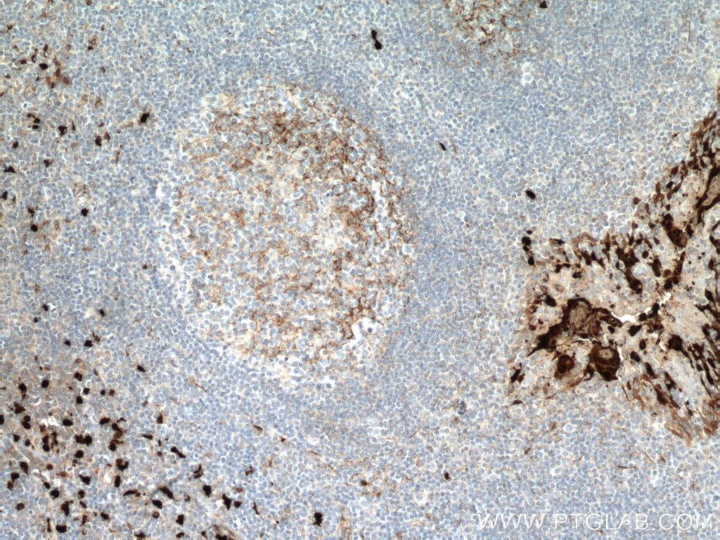 Immunohistochemistry (IHC) staining of human tonsillitis tissue using S100A8 Monoclonal antibody (66853-1-Ig)