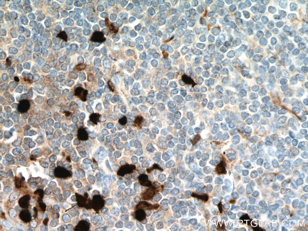 Immunohistochemistry (IHC) staining of human tonsillitis tissue using S100A8 Monoclonal antibody (66853-1-Ig)