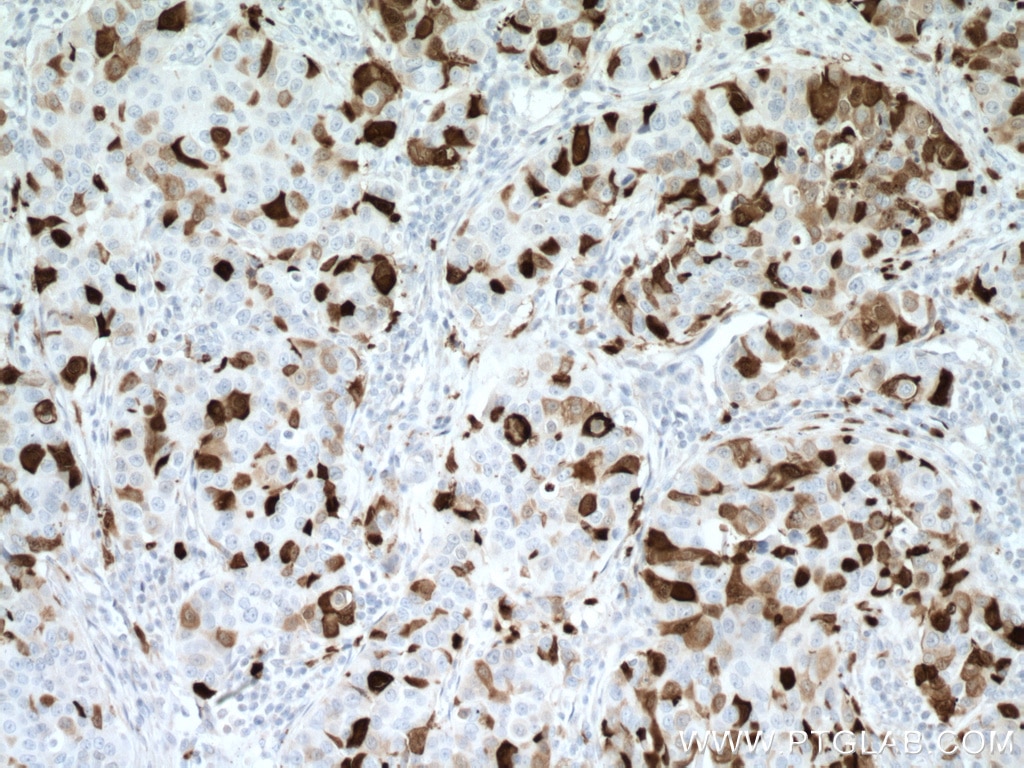 Immunohistochemistry (IHC) staining of human breast cancer tissue using S100A8 Monoclonal antibody (66853-1-Ig)