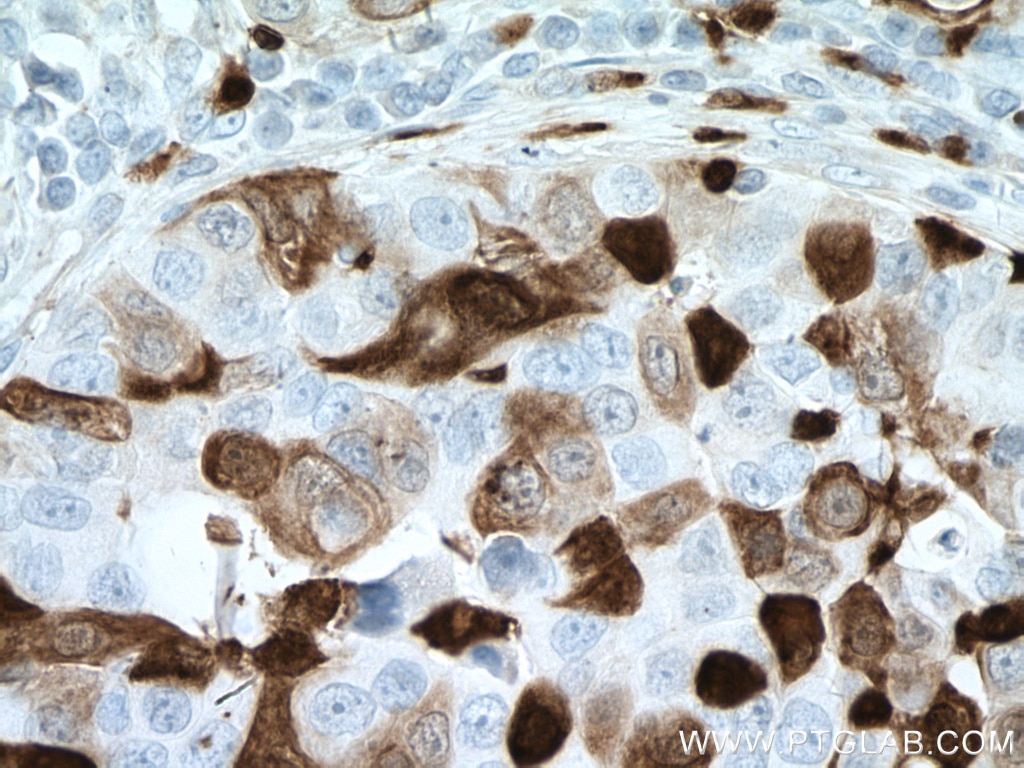 Immunohistochemistry (IHC) staining of human breast cancer tissue using S100A8 Monoclonal antibody (66853-1-Ig)