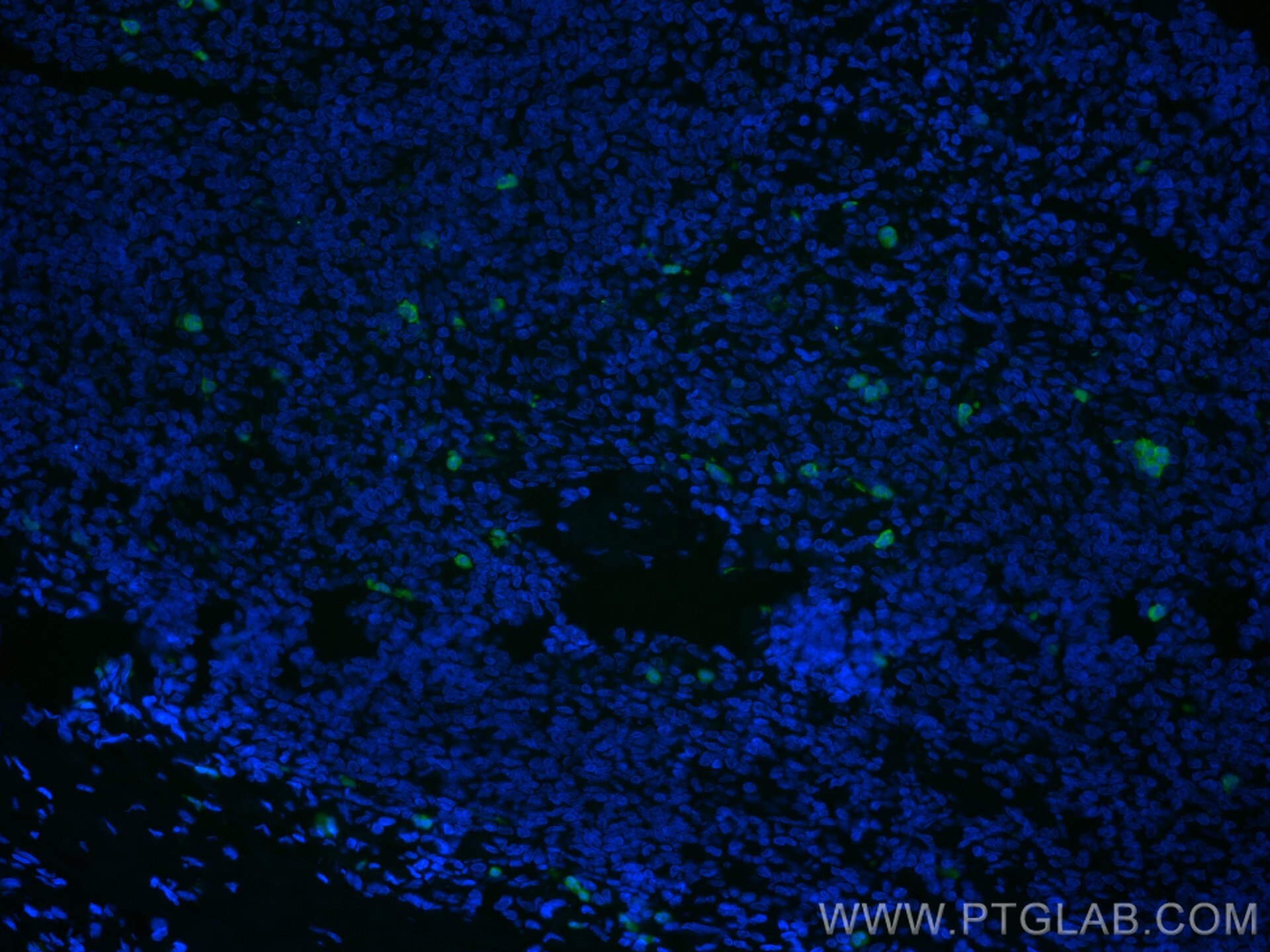 Immunofluorescence (IF) / fluorescent staining of human tonsillitis tissue using CoraLite® Plus 488-conjugated S100A8 Monoclonal an (CL488-66853)