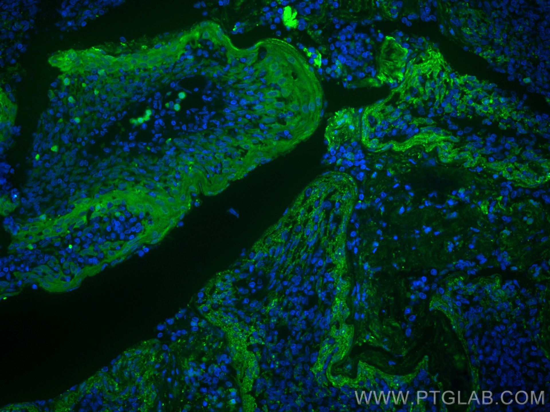 Immunofluorescence (IF) / fluorescent staining of human tonsillitis tissue using CoraLite® Plus 488-conjugated S100A8 Monoclonal an (CL488-66853)