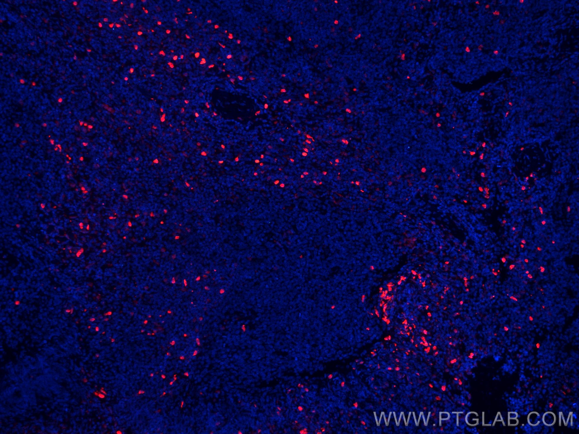 Immunofluorescence (IF) / fluorescent staining of human tonsillitis tissue using CoraLite®594-conjugated S100A8 Monoclonal antibody (CL594-66853)