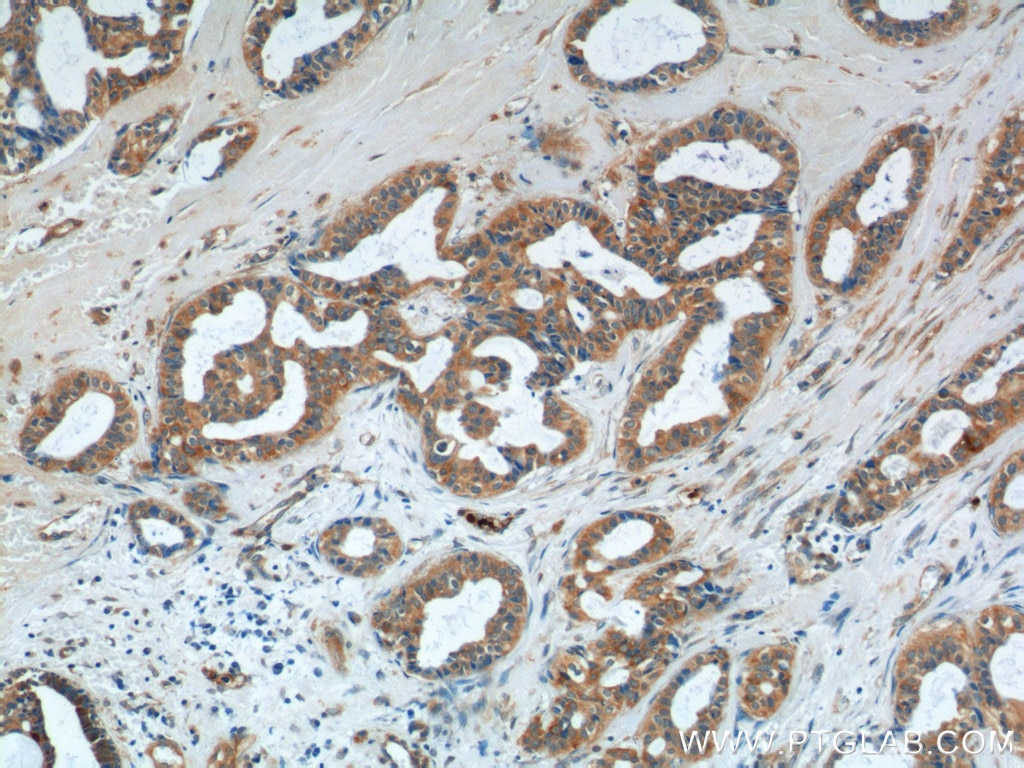 Immunohistochemistry (IHC) staining of human breast cancer tissue using S100A9 Polyclonal antibody (14226-1-AP)