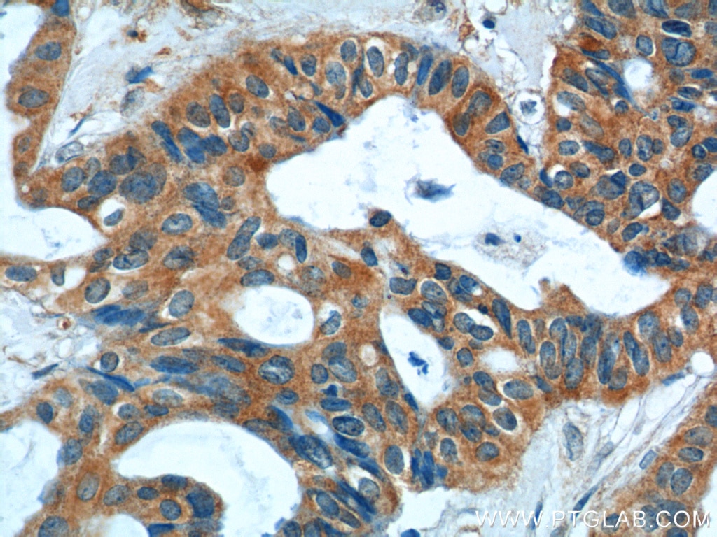 Immunohistochemistry (IHC) staining of human breast cancer tissue using S100A9 Polyclonal antibody (14226-1-AP)