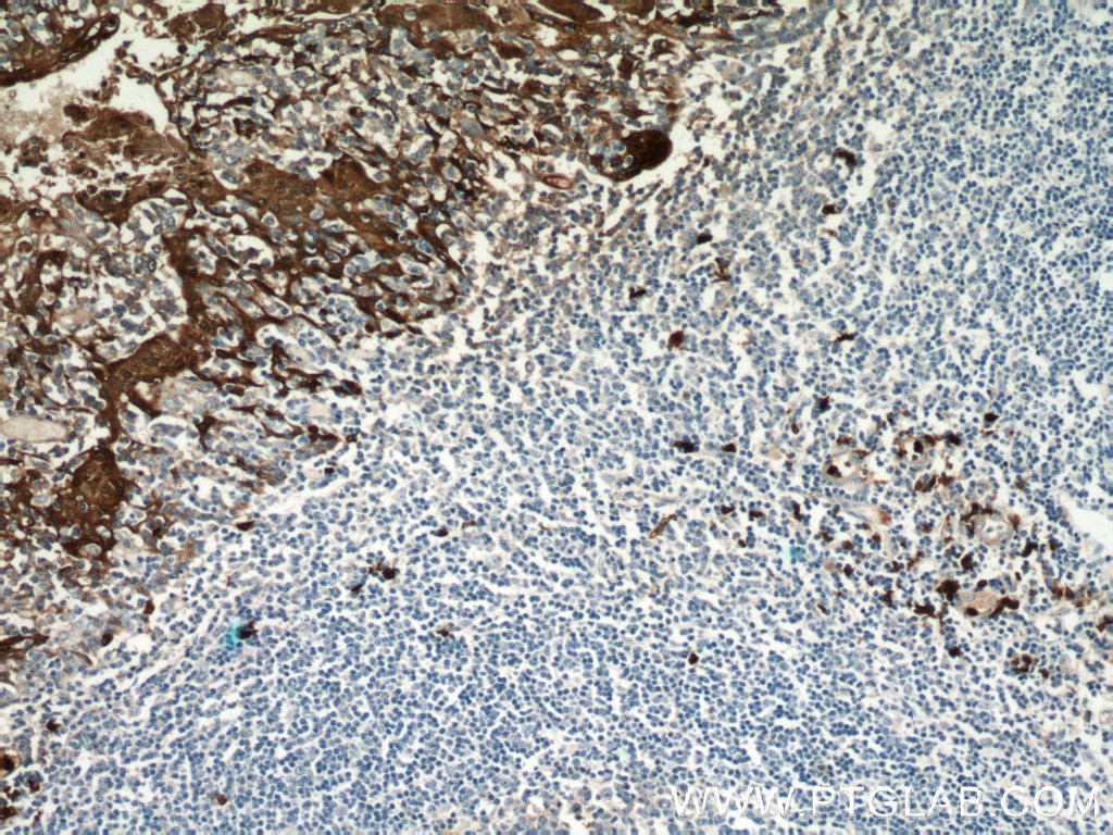 Immunohistochemistry (IHC) staining of human tonsillitis tissue using S100A9 Polyclonal antibody (14226-1-AP)