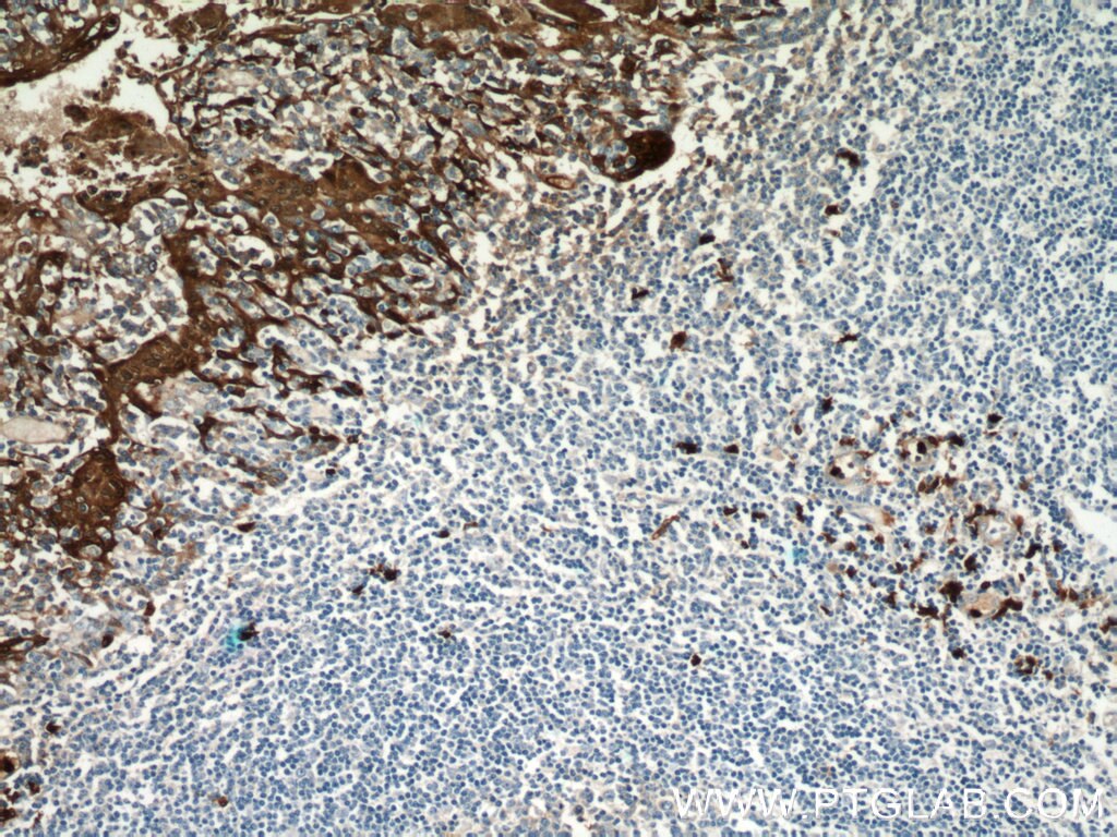 IHC staining of human tonsillitis using 14226-1-AP