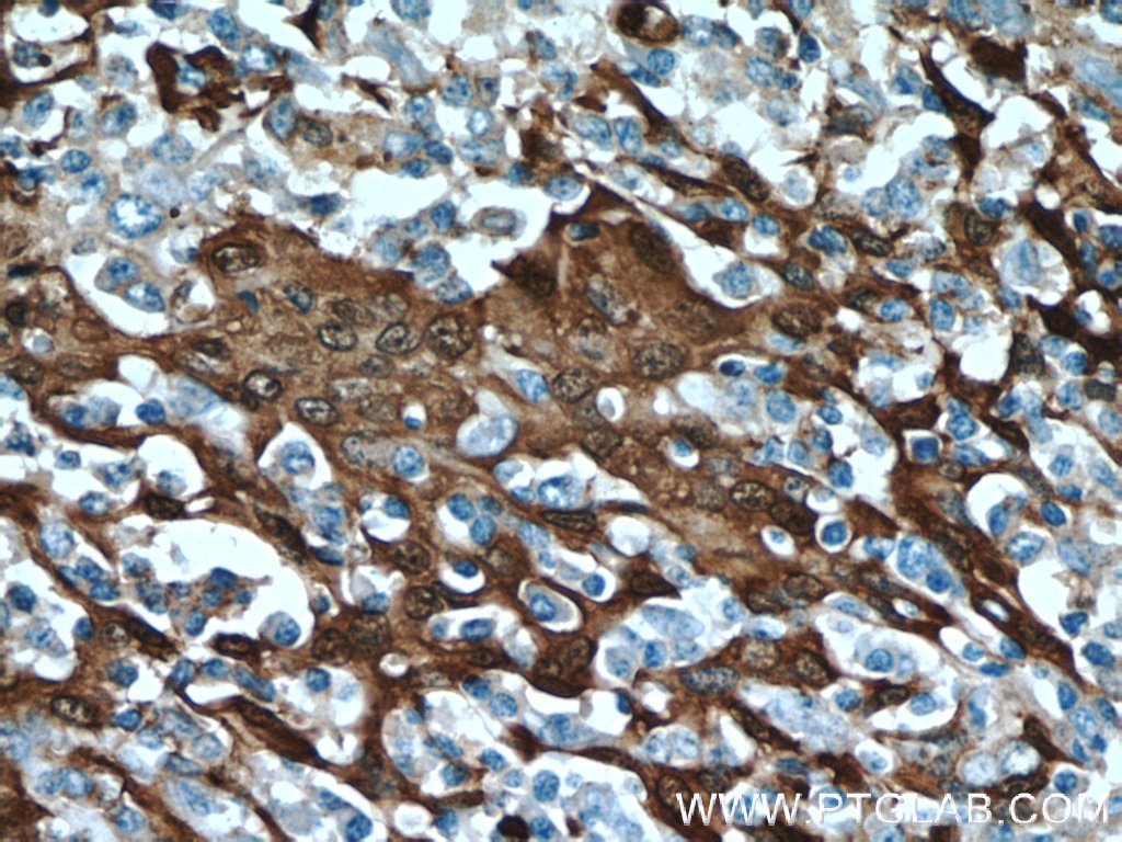 Immunohistochemistry (IHC) staining of human tonsillitis tissue using S100A9 Polyclonal antibody (14226-1-AP)