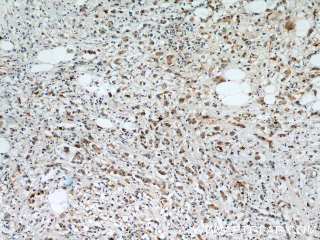 Immunohistochemistry (IHC) staining of human breast cancer tissue using S100A9 Polyclonal antibody (14226-1-AP)