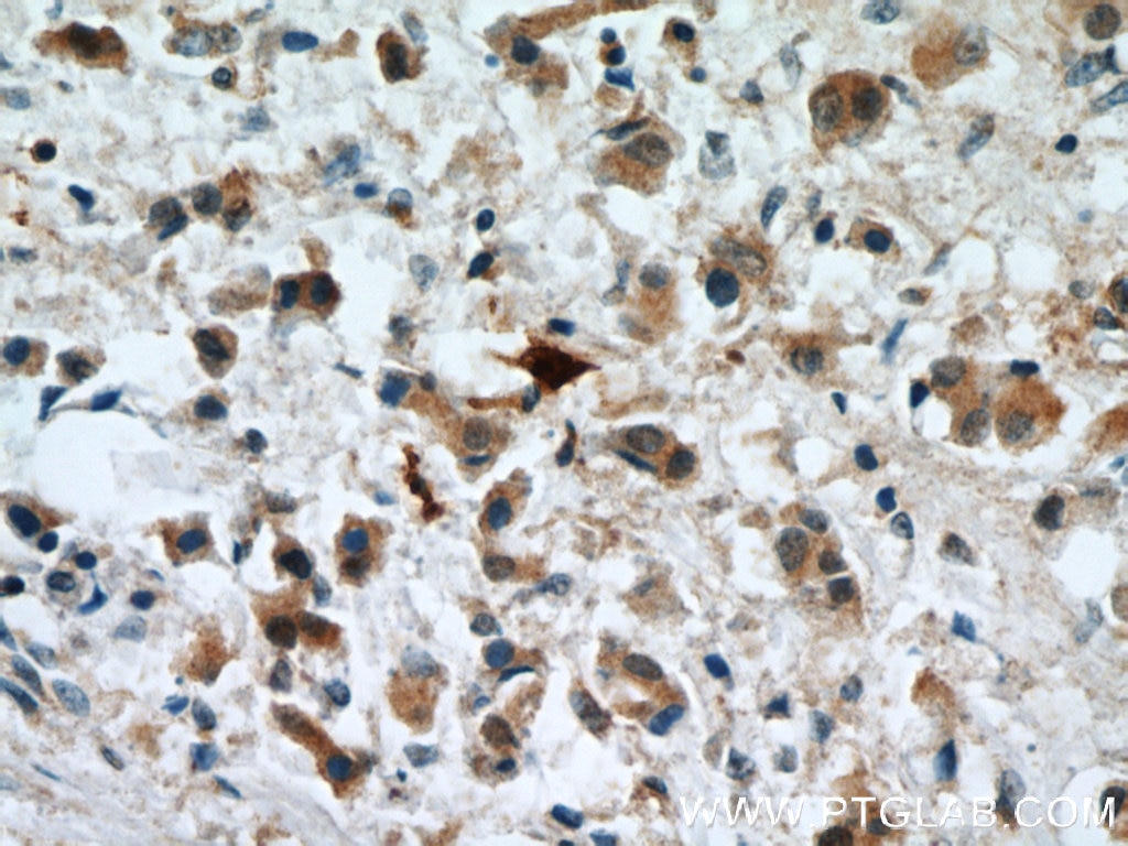 Immunohistochemistry (IHC) staining of human breast cancer tissue using S100A9 Polyclonal antibody (14226-1-AP)