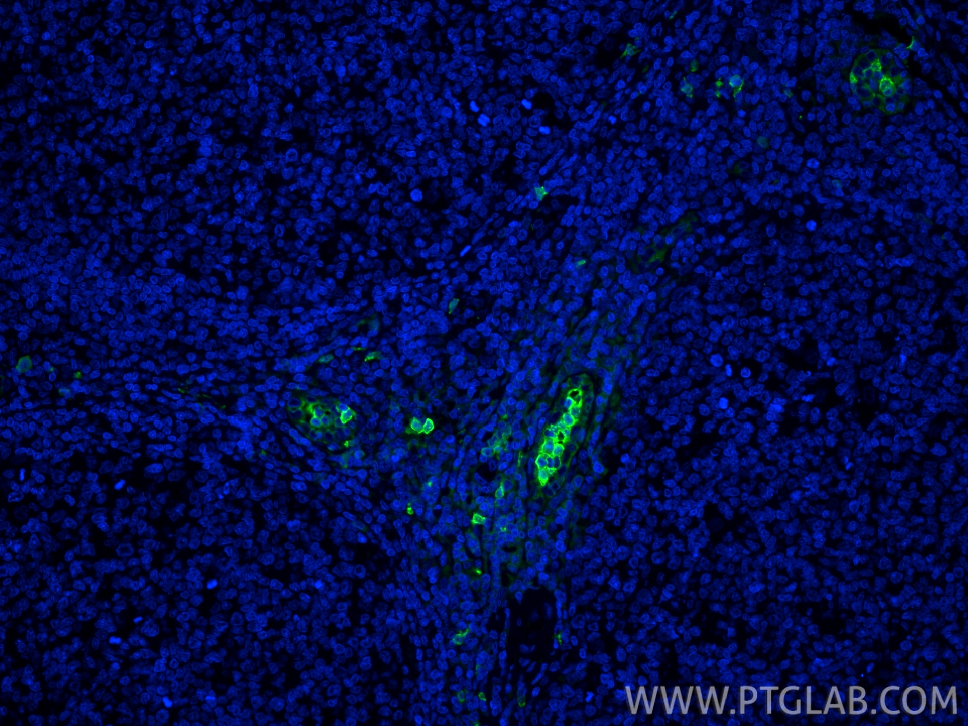 Immunofluorescent analysis of (4% PFA) fixed paraffin-embedded human tonsillitis tissue using S100A9 antibody (26992-1-AP) at dilution of 1:200 and CoraLite®488-Conjugated Goat Anti-Rabbit IgG(H+L) (SA00013-2). Heat mediated antigen retrieval with Tris-EDTA buffer (pH 9.0). Immunofluorescence (IF) / fluorescent staining of human tonsillitis tissue using S100A9 Polyclonal antibody (26992-1-AP)