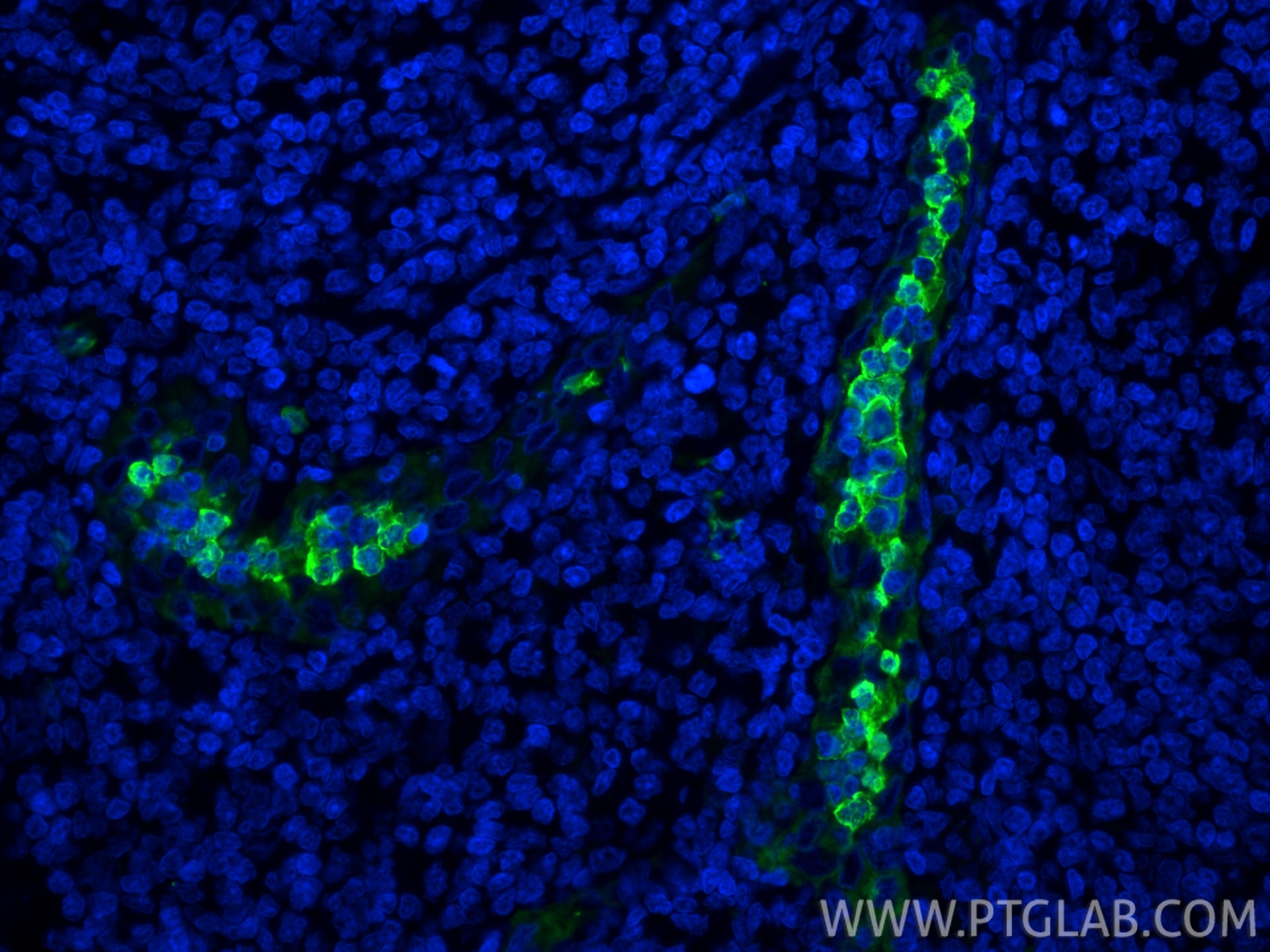 Immunofluorescent analysis of (4% PFA) fixed paraffin-embedded human tonsillitis tissue using S100A9 antibody (26992-1-AP) at dilution of 1:200 and CoraLite®488-Conjugated Goat Anti-Rabbit IgG(H+L) (SA00013-2). Heat mediated antigen retrieval with Tris-EDTA buffer (pH 9.0). Immunofluorescence (IF) / fluorescent staining of human tonsillitis tissue using S100A9 Polyclonal antibody (26992-1-AP)
