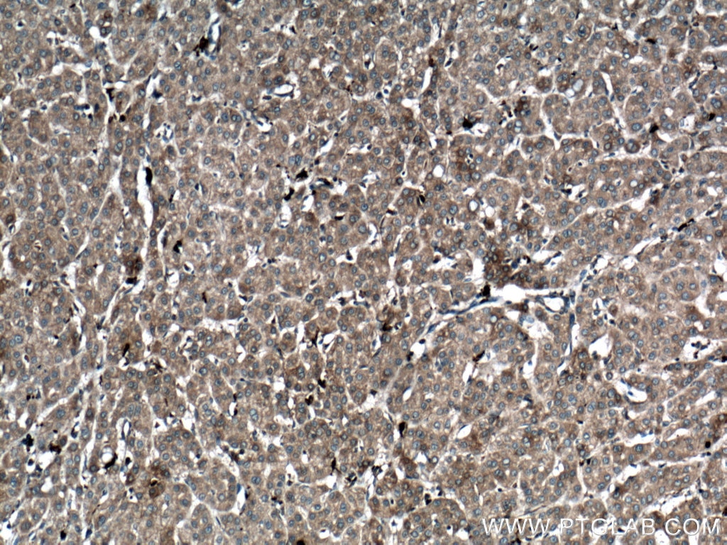 Immunohistochemistry (IHC) staining of human liver cancer tissue using S100A9 Polyclonal antibody (26992-1-AP)