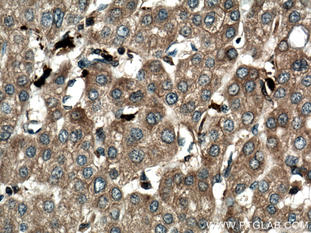 Immunohistochemistry (IHC) staining of human liver cancer tissue using S100A9 Polyclonal antibody (26992-1-AP)