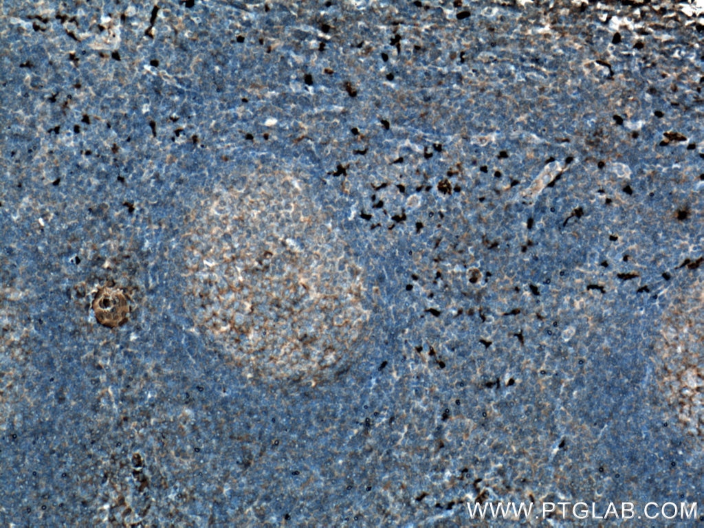 Immunohistochemistry (IHC) staining of human tonsillitis tissue using S100A9 Polyclonal antibody (26992-1-AP)