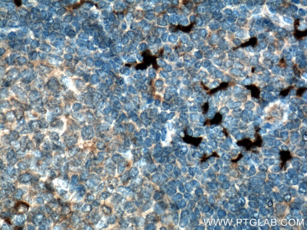 Immunohistochemistry (IHC) staining of human tonsillitis tissue using S100A9 Polyclonal antibody (26992-1-AP)