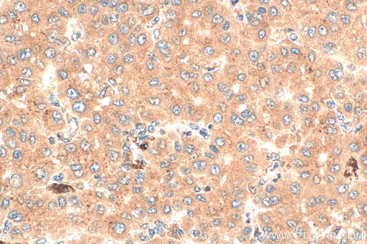 Immunohistochemistry (IHC) staining of human liver cancer tissue using S100A9 Polyclonal antibody (26992-1-AP)