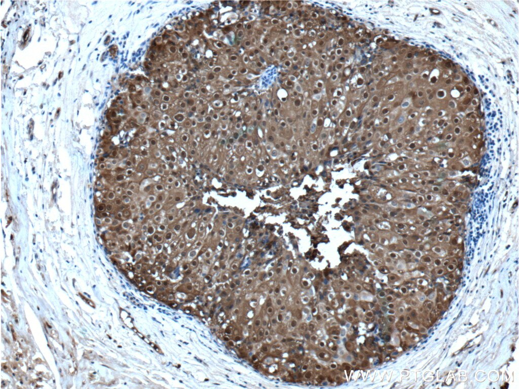 Immunohistochemistry (IHC) staining of human breast cancer tissue using S100A9 Polyclonal antibody (26992-1-AP)